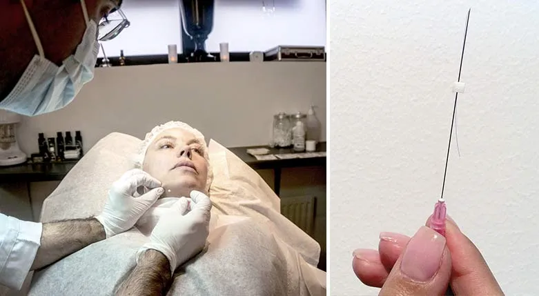 151011-threadlifting